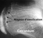 maladie sever radiographie