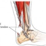 rupture tendon d achille