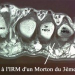 morton