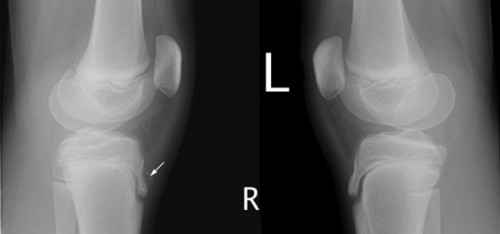 osgood schlatter