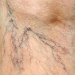 10678_varice2.85