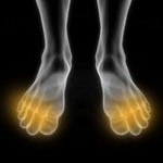 Maladie de raynaud